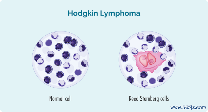 Hình ảnh tế bào thông thường và tế bào mắc bệnh ung thư hạch Hodgkin. Ảnh: Lymphoma Australia